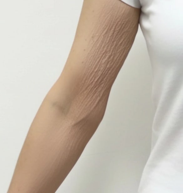 Antes, brazo