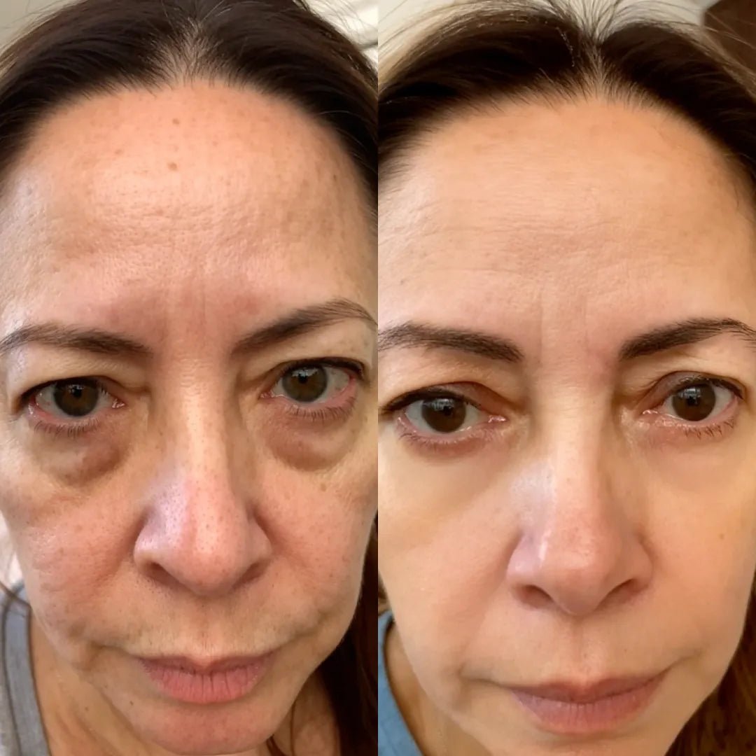Antes y después: la sombra bajo el ojo se aclara