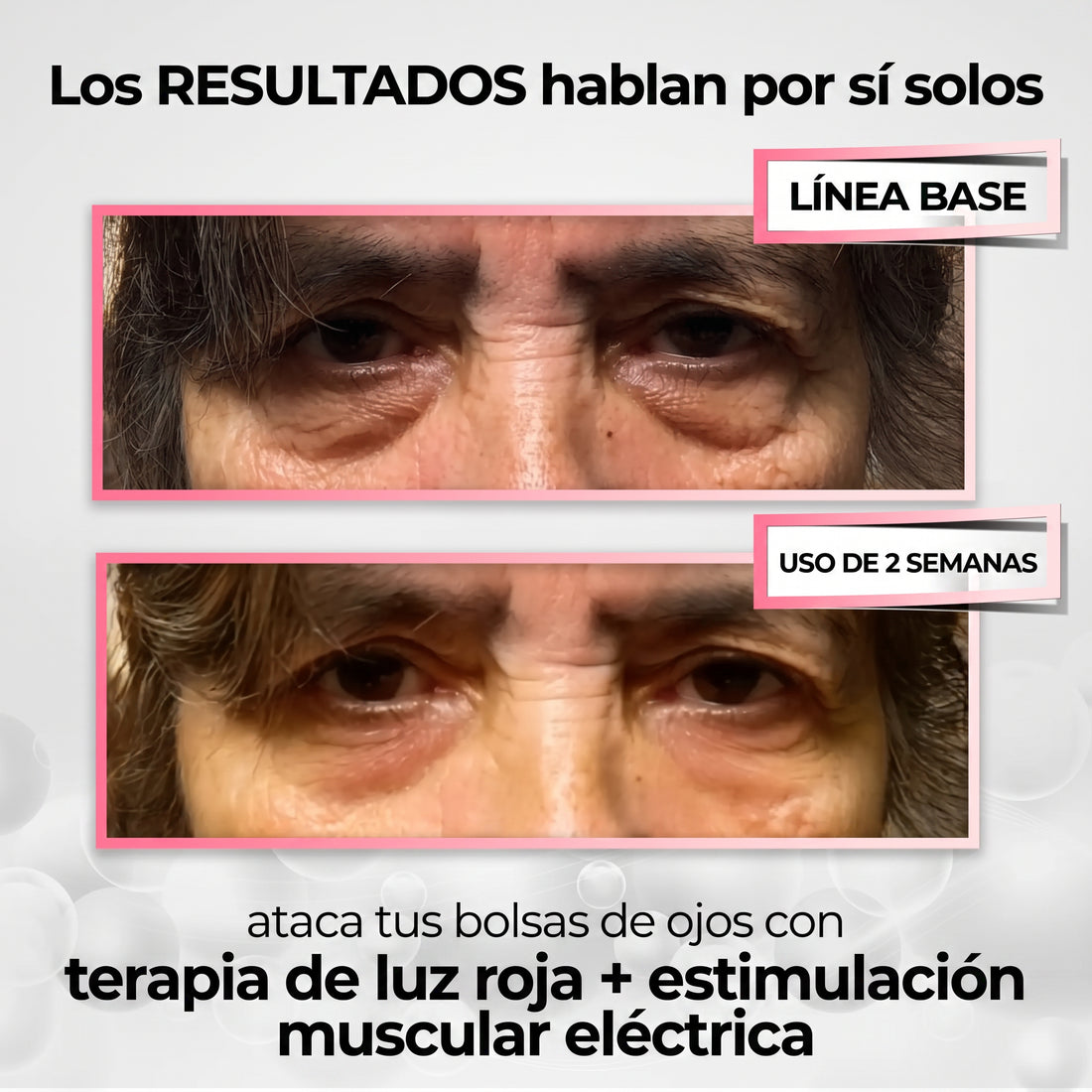 Lumavie™ Lentes de Rehabilitación de Ojeras