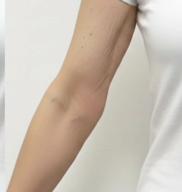 Después, brazo