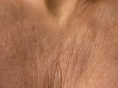 Antes, cuello